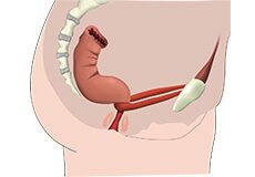 bowel-incontinence-9319753