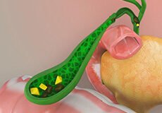 choledocholithiasis-9472334