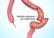 colitis-5063546