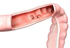 colon-cancer-6510438