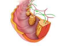 colorectal-cancer-2122836