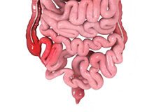 crohns-disease-9564648