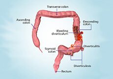 diverticular-disease-8092576
