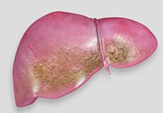 fatty-liver-disease-5439523