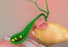 gallstones-5264550