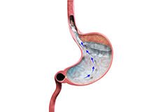 gastroesophageal-reflux-disease-4624285