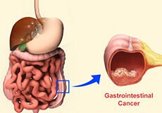 gastrointestinal-cancer-2663359