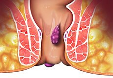 hemorrhoids-6690815