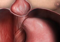 hiatal-hernia-6006303