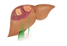 liver-cancer-8483668