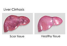liver-cirrhosis-6172234