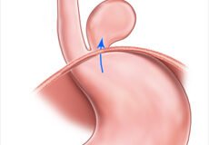 paraesophageal-hernia-3849650