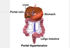 portal-hypertension-4522255