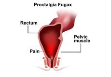 proctalgia-fugax-1470258