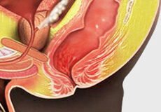 rectal-bleeding-4527271