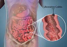 ulcerataive-colitis-8769270